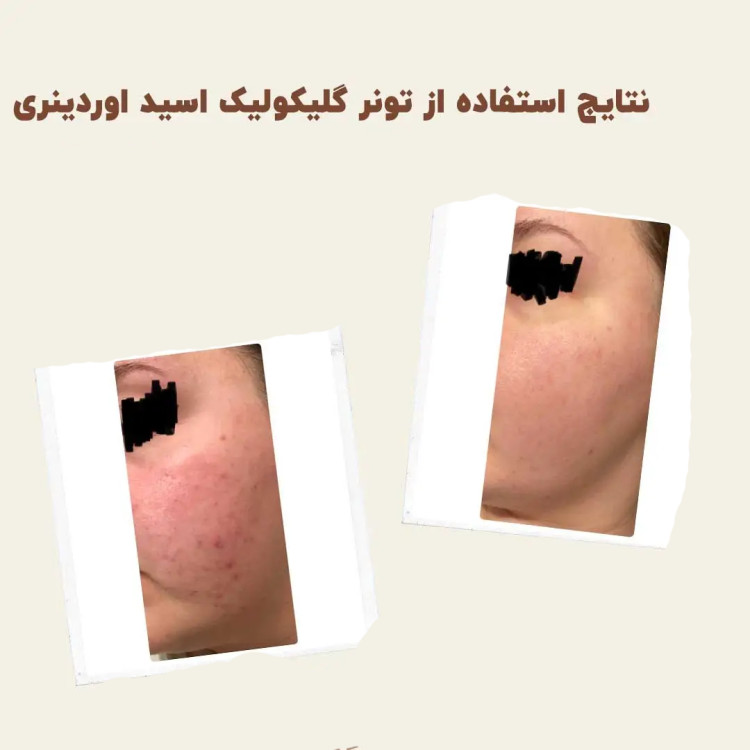 قبل و بعد از استفاده از تونر گلیکولیک اوردینری